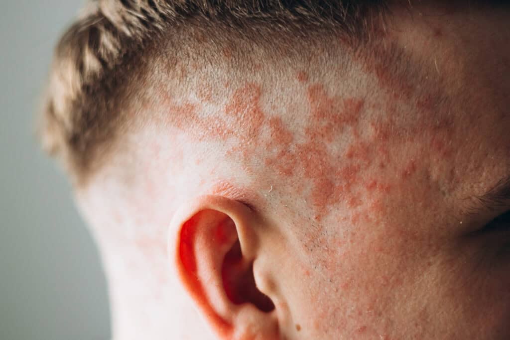 Nahaufnahme einer gereizten Kopfhaut mit möglichen Symptomen wie Schuppen und Pilzbefall, oft ein Fall für dermatologische Hilfe.