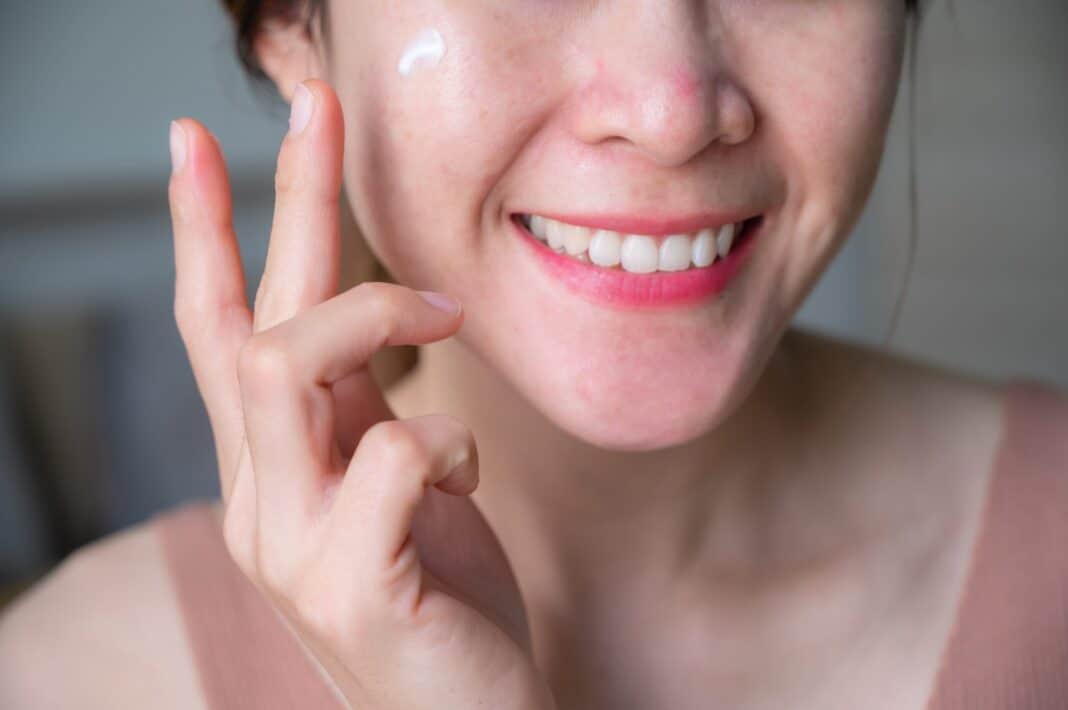 Auftragen einer Pigmentflecken Creme auf die Wange, die hilft, unerwünschte Hyperpigmentierung zu reduzieren